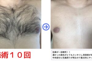 メンズの胸脱毛、始めるなら今！清潔感と自信を手に入れる第一歩【RASHINDO大和店】
